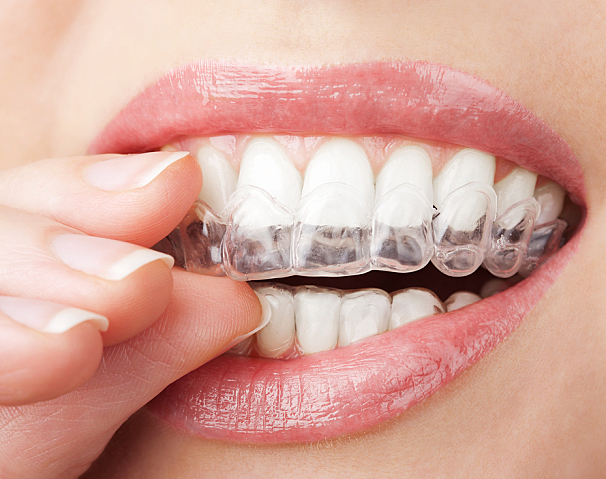 teeth-whitening-tray.jpg