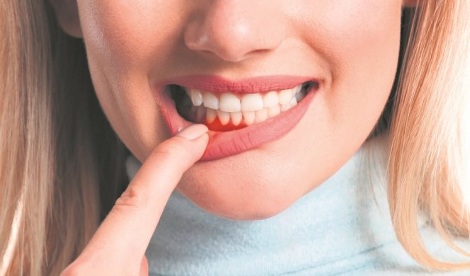 506904_xstock-photo-woman-with-gum-inflammation-closeup-1512839855_f